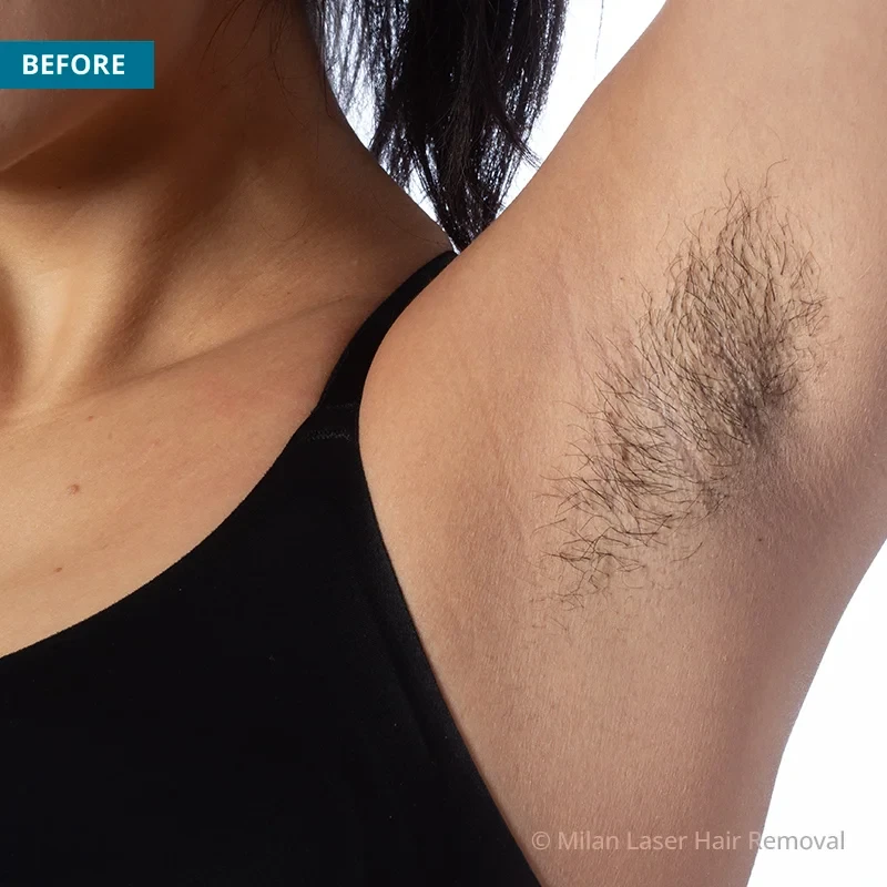 Underarm Before & After Photos of Laser Hair Removal | Milan Laser in  Columbus, OH